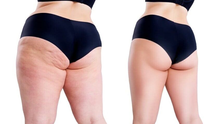 Liposuccion des jambes complètes dans le lipœdème sévère