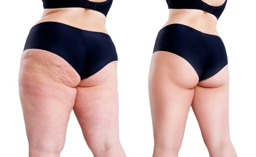 Liposuccion des jambes complètes dans le lipœdème sévère