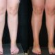 Liposuccion des mollets en cas de lipœdème