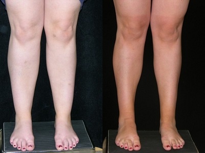 Liposuccion des mollets en cas de lipœdème