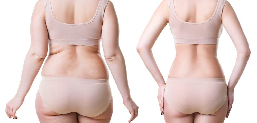 Liposuccion et zones rebelles à la graisse : ventre, culotte de cheval, double menton