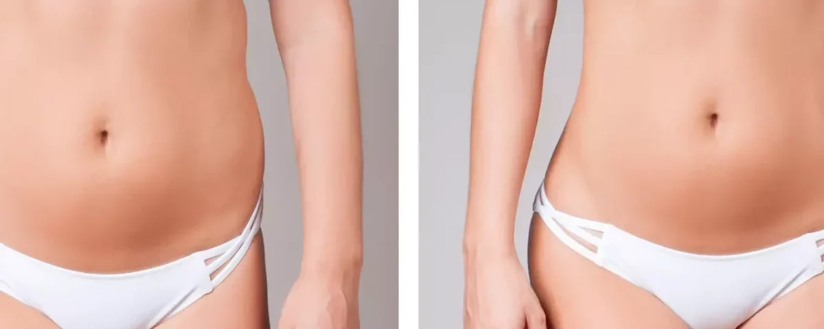 Suites opératoires du RIBXCAR protocole Dr Youssef Gam