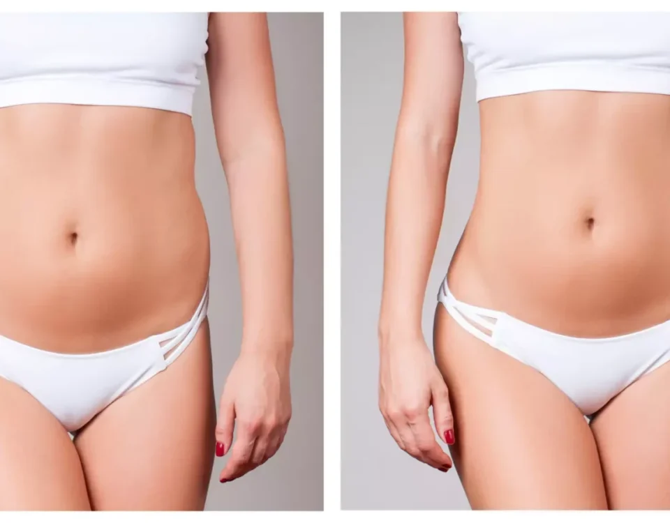 Suites opératoires du RIBXCAR protocole Dr Youssef Gam