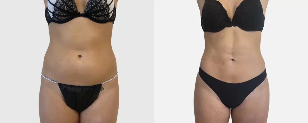 Vaser Lipo et Lipœdème
