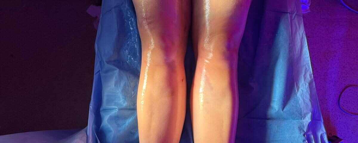 4D lipo et lipœdème