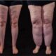 ArgoPlasma et remodelage cutané après liposuccion du lipœdème