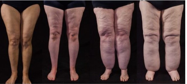 ArgoPlasma et remodelage cutané après liposuccion du lipœdème