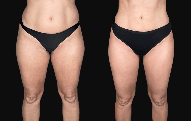 High Definition Lipedema Surgery en Tunisie