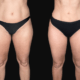 High Definition Lipedema Surgery en Tunisie