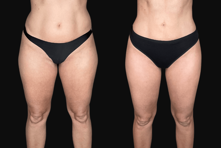 High Definition Lipedema Surgery en Tunisie