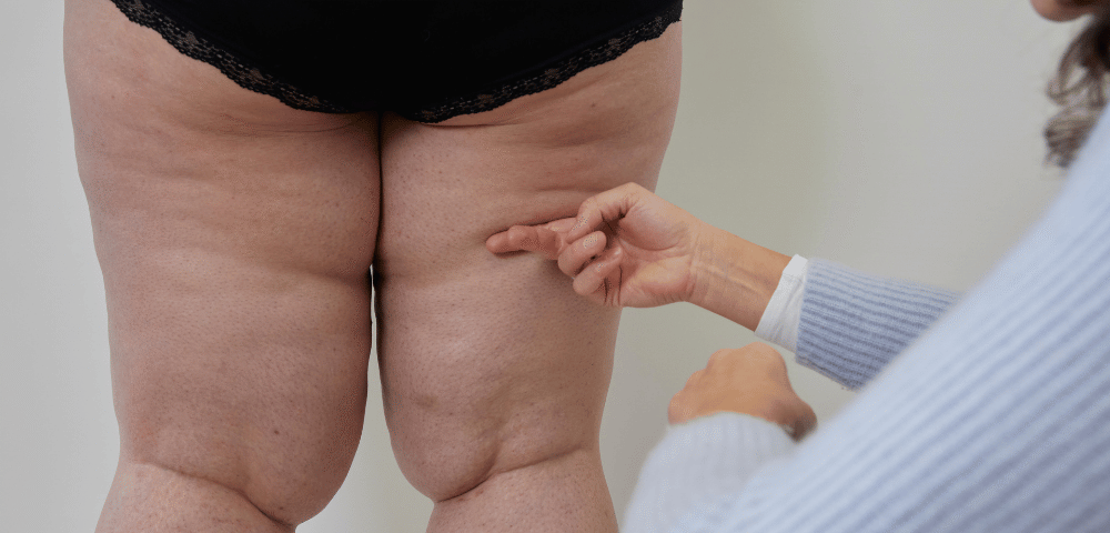 Lipœdème des jambes