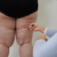 Lipœdème des jambes