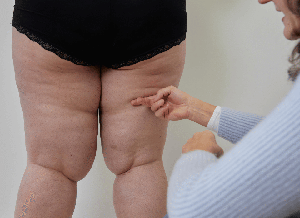 Lipœdème des jambes