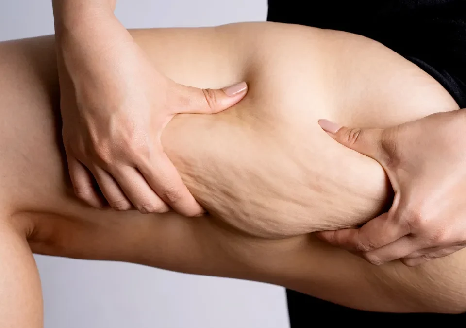 Lipœdème ou cellulite sévère