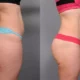 Liposuccion WAL vs PAL vs VASER pour le lipœdème