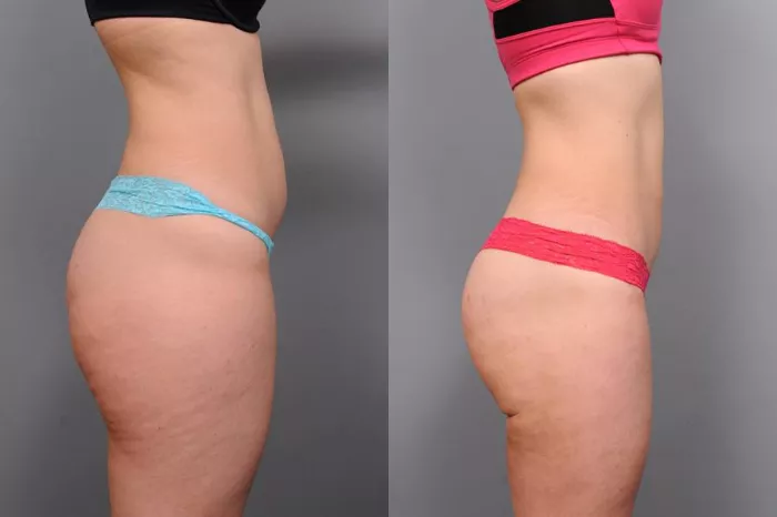 Liposuccion WAL vs PAL vs VASER pour le lipœdème