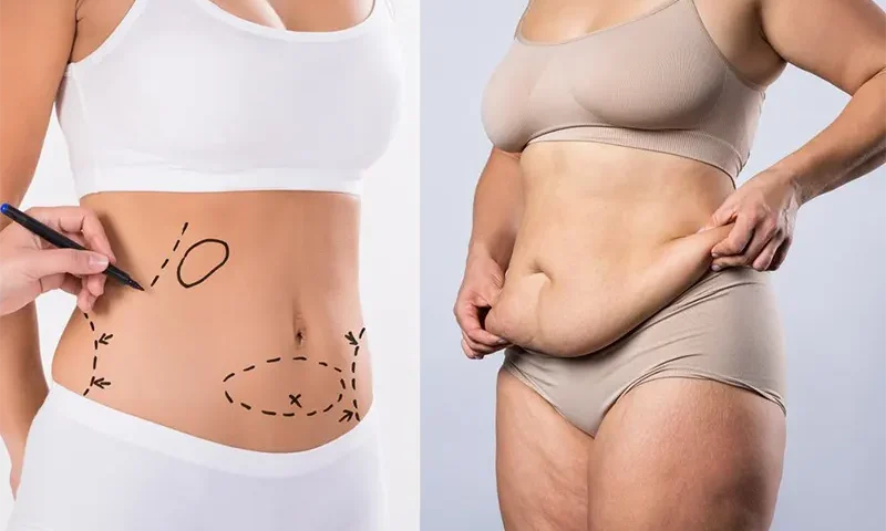 Liposuccion du ventre chez les patientes atteintes de lipœdème