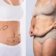Liposuccion du ventre chez les patientes atteintes de lipœdème