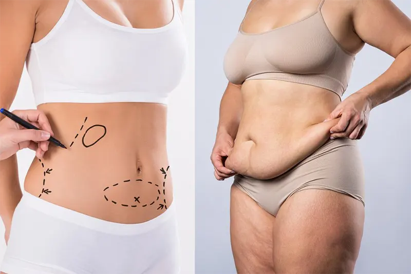 Liposuccion du ventre chez les patientes atteintes de lipœdème