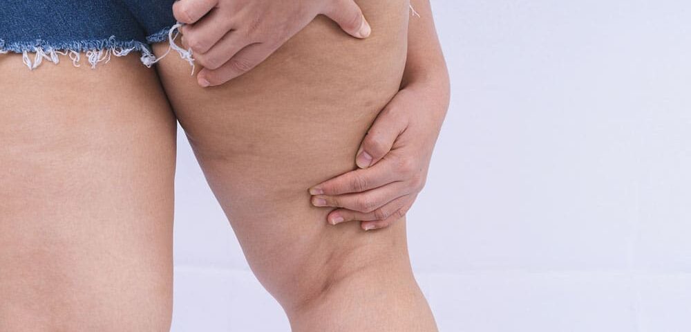Liposuccion tumescente et lipœdème