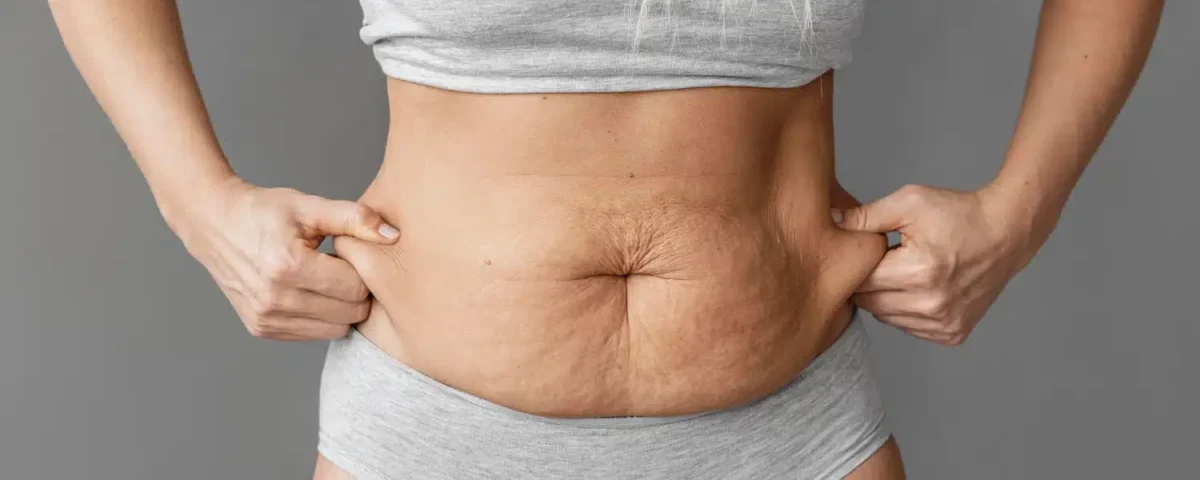 Lipœdème et relâchement abdominal