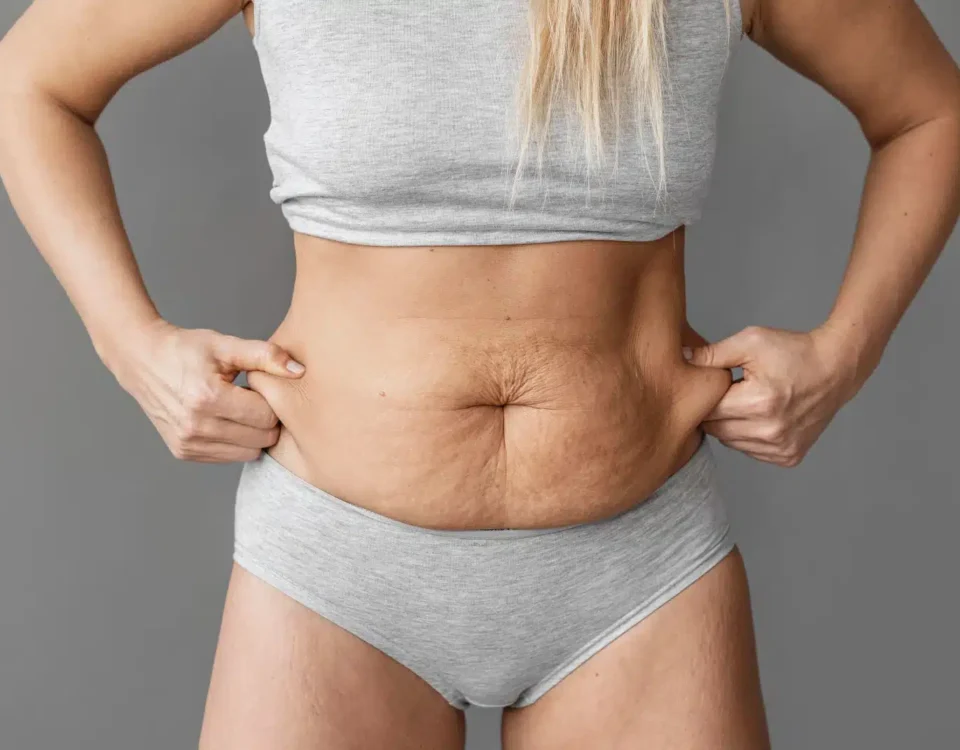 Lipœdème et relâchement abdominal