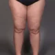 Liposuccion du lipœdème sévère