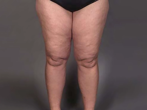 Liposuccion du lipœdème sévère