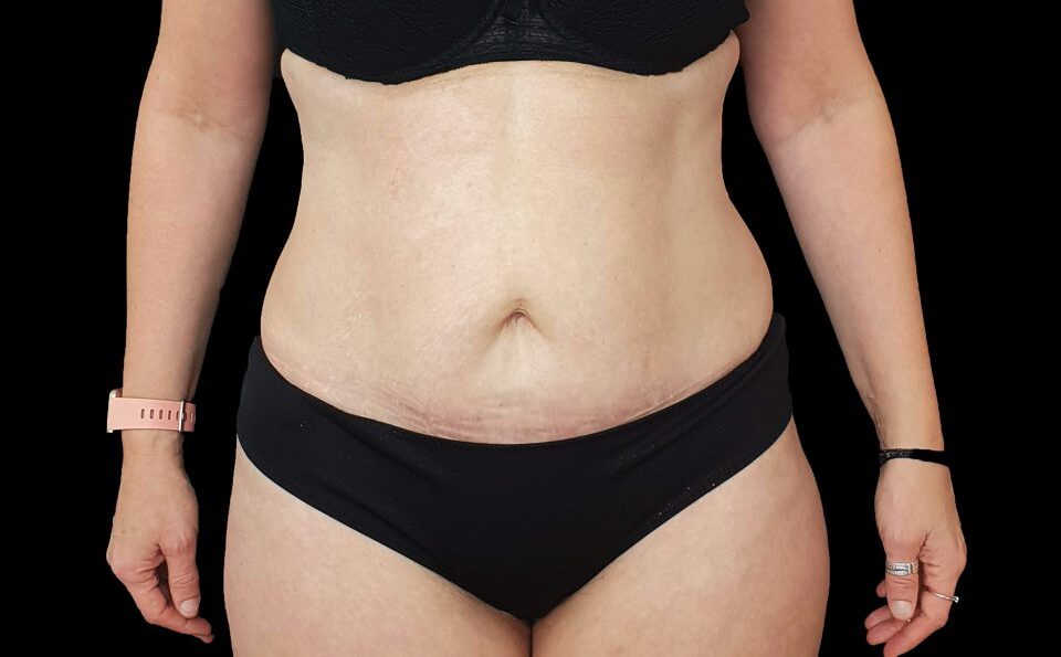 Liposuccion HD et sculpture abdominale