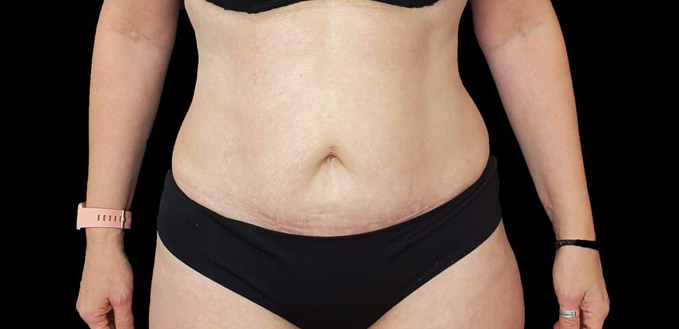 Liposuccion HD et sculpture abdominale
