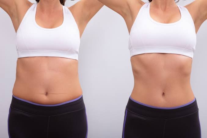 Liposuccion VASER 360°