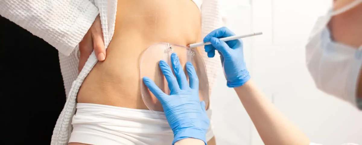 Liposuccion avec transfert de graisse