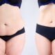 Liposuccion et Mommy Makeover