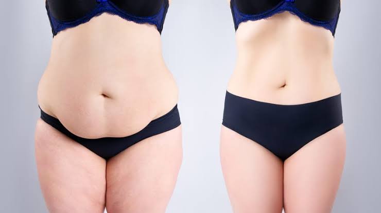 Liposuccion et Mommy Makeover