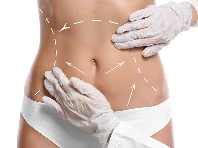 Traitement du lipœdème par liposuccion 360°