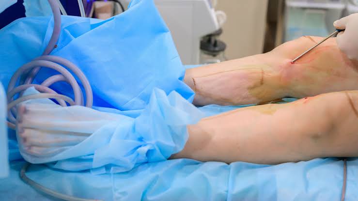 Liposuccion des chevilles et des mollets