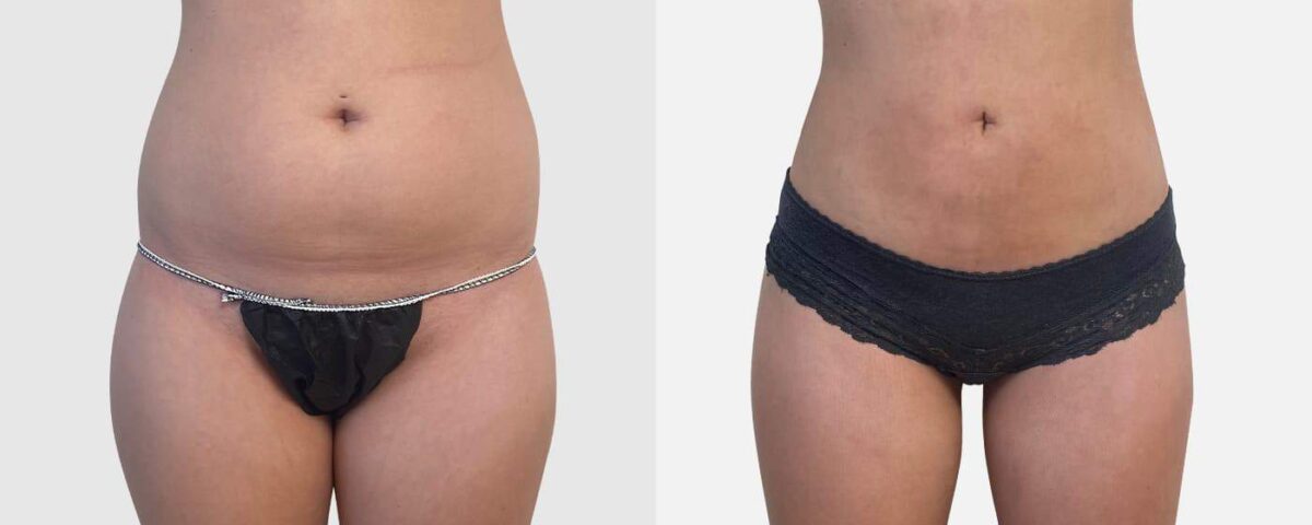 Liposuccion du ventre inférieur