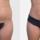 Liposuccion du ventre inférieur