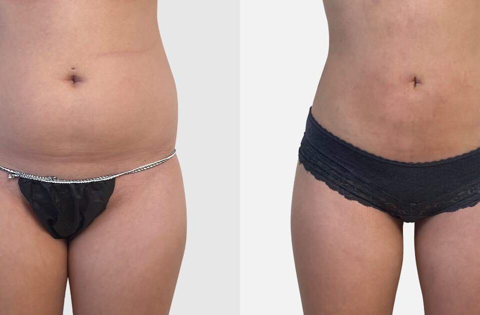 Liposuccion du ventre inférieur