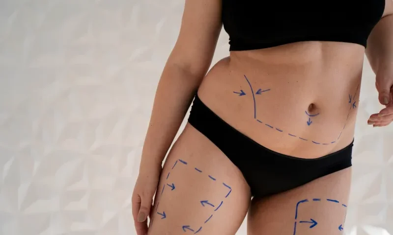 Liposuccion et reconstruction corporelle après une perte de poids