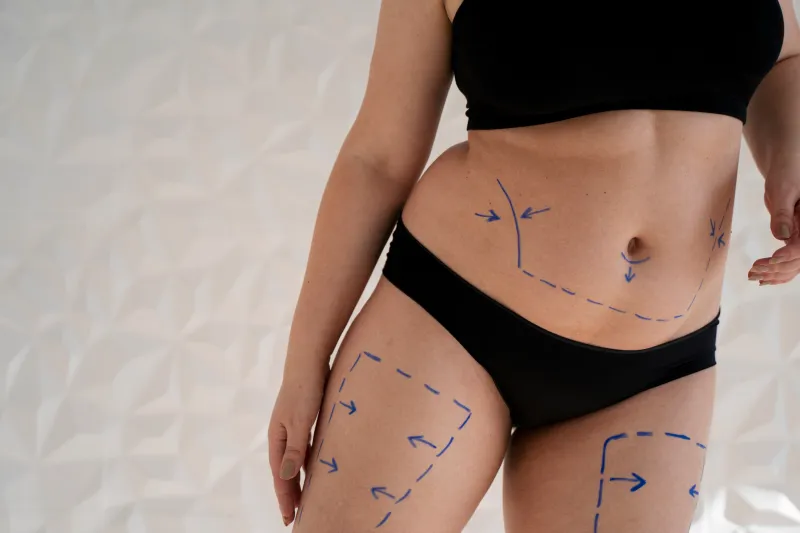 Liposuccion et reconstruction corporelle après une perte de poids