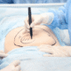 Liposuccion et technologies modernes