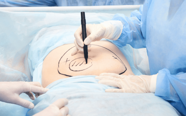 Liposuccion et technologies modernes