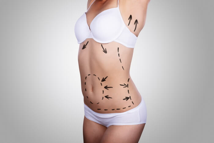 Liposculpture HD et BodyTite RFAL en Tunisie