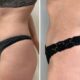 Liposuccion + Morpheus8