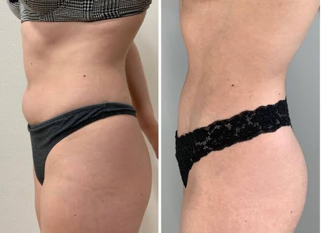 Liposuccion et Renuvion