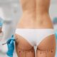Liposuccion et lipofilling des hanches