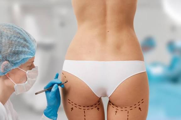 Liposuccion et lipofilling des hanches