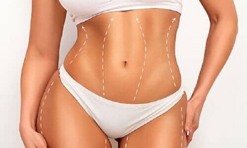 J-Plasma et Renuvion après liposuccion