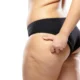 Liposuccion du lipœdème